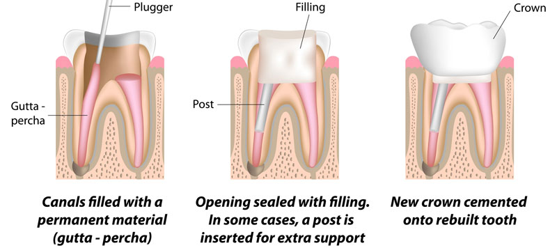 Root Canal Therapy Process