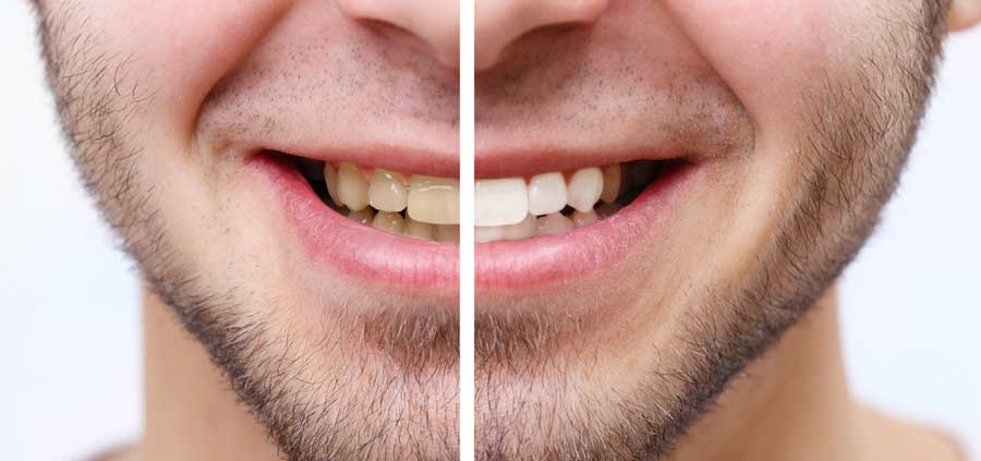 Professional Teeth Whitening Before & After Illustration
